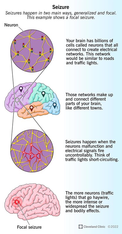 Seizure: What It Is, Causes, Symptoms, Treatment & Types