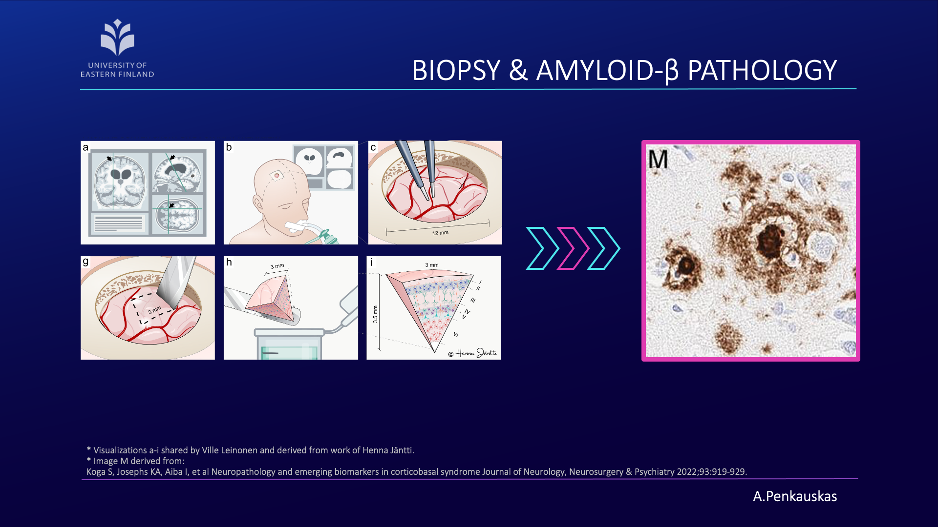 Acquisition of biopsy and amyloid pathology positive scan